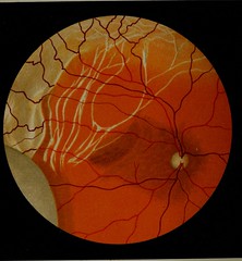 Anglų lietuvių žodynas. Žodis retinal detachment reiškia tinklainės atšoka lietuviškai.